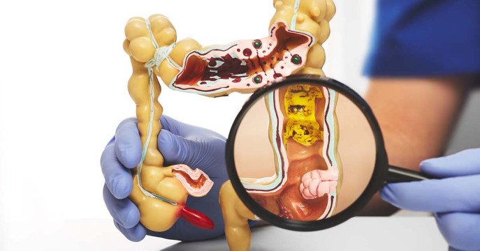 تغییرات ژنتیکی و اپی ژنتیکی در سرطان کولورکتال: از مکانیسم‌های مولکولی تا تشخیص و درمان